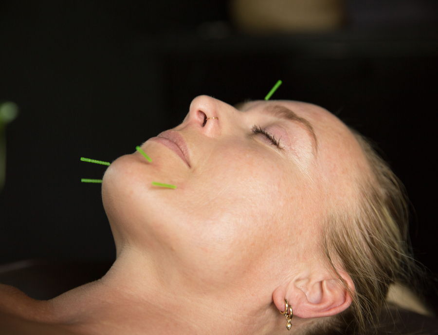 Fine acupuncture needles placed along the cheek and jaw during cosmetic facial rejuvenation