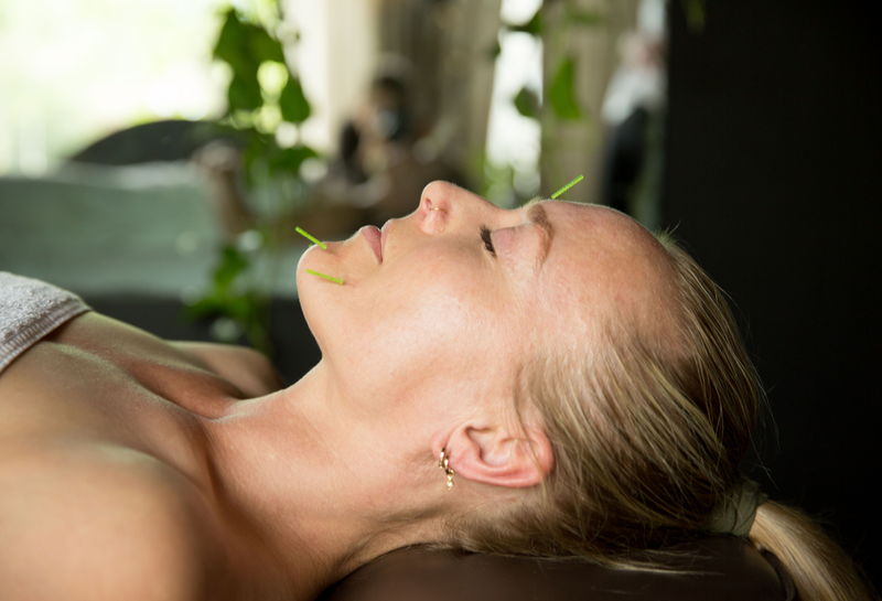 Fine acupuncture needles placed across the face during cosmetic facial rejuvenation